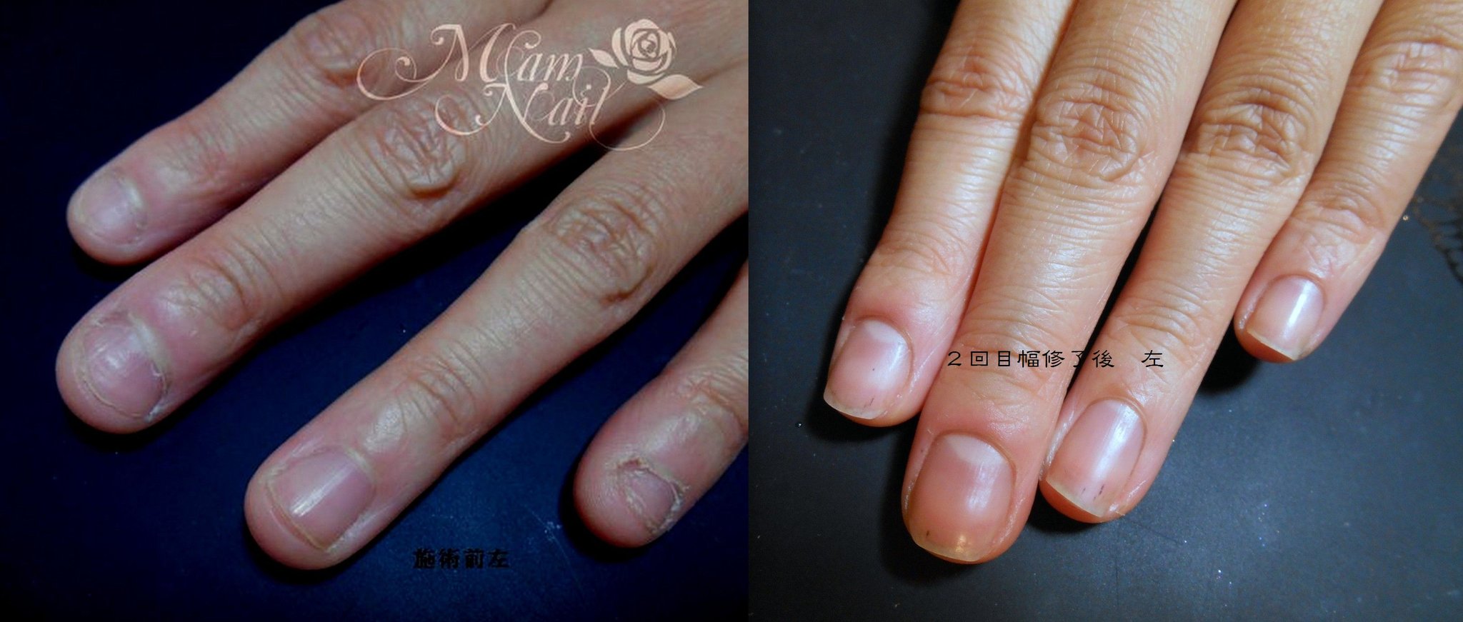 富士市深爪矯正/初回施術前→コース二回目の６回目施術・修了後