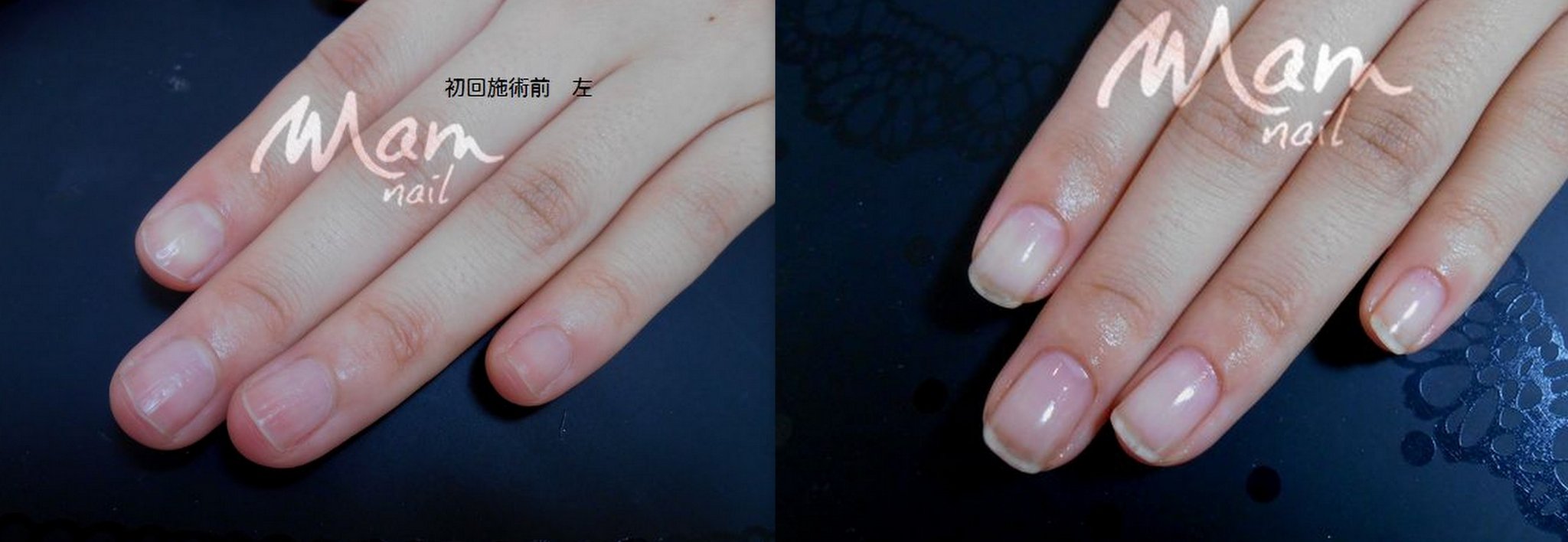 富士市深爪矯正/深爪軽度