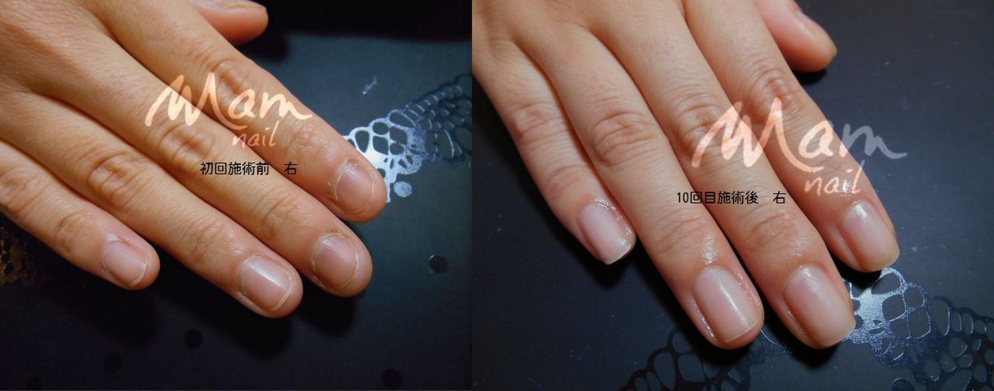 富士市深爪矯正/深爪重度