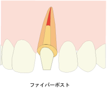 ファイバーポスト