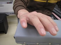 突き指　　　　国分寺こみね鍼灸整骨院