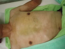 胸部に薄く内出血が広がっています　国分寺こみね鍼灸整骨院