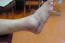 「ねんざ」　右外側靱帯損傷