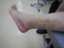 剥離骨折　陳旧性骨折　靭帯損傷　国分寺こみね鍼灸整骨院