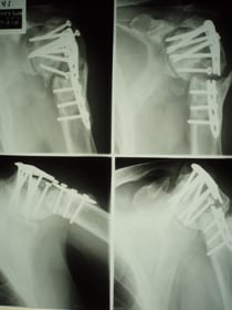 上腕骨頸部骨折　外科手術　数多くのボルトを打ち込み固定、金属が折れてしまった。国分寺こみね鍼灸整骨院