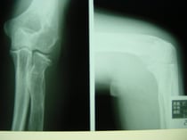 骨折リハビリ　肘の骨折　　保存療法　国分寺こみね鍼灸整骨院