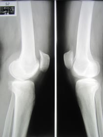お年寄り　膝の痛み　椅子から立ち上がった時　階段を降りる時　国分寺こみね鍼灸整骨院