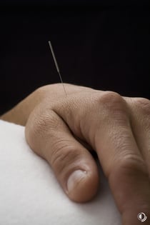 Akupunktur