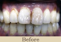 ガムブリーチ前