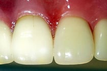 自然なセラミックの歯