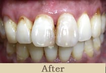 ガムブリーチ後