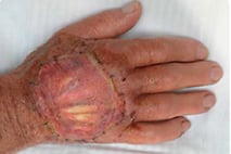 PPM Fisteladapter Produktfoto