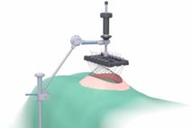 PPM Fisteladapter Produktfoto