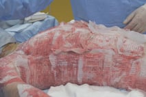 PPM Fisteladapter Produktfoto