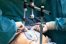 PPM Fisteladapter Produktfoto