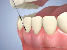 歯周ポケット検査１