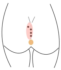 sinus pilonidalis Karydakis operation