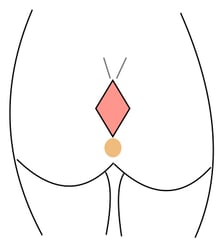 Sinus pilonidalis Limberg operation
