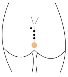Karydakis operation pilonidal cyst