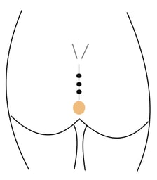 Limberg operation pilonidal cyst