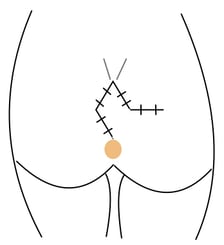 Sinus pilonidalis Limberg operation
