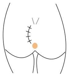 sinus pilonidalis Karydakis operation