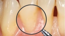 ParoSphère | Focus sur le traitement des récessions gingivales