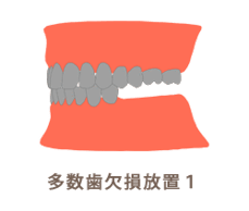 多数歯欠損放置1