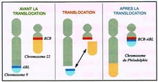 lmc frane leucemie myeloide chronique chromosome 9 22 translocation bcr abl bcr-abl anomalie génétique