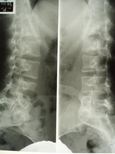 分離症　すべり症　腰痛　国分寺こみね鍼灸整骨院