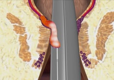 Die Hämorrhoide schrumpft nach der Laserbehandlung - Proktologie Berlin