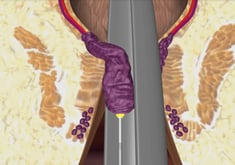 1. Die Laserfaser wird unter Sicht genau im Zentrum des Hämorrhoidenpolsters platziert.