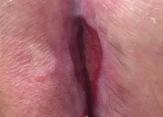 Wundheilung bei Sinus pilonidalis