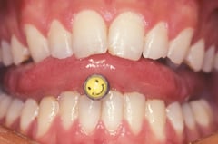 Piercing et gencive © ParoSphère