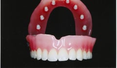 Schleimhautanker entwickelt von Dr. Engels