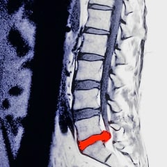 Resonancia magnética con hernia lumbar