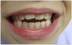 Offener Biss: Die Schneidezähne stehen auseinander. (© Doc S)