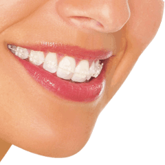 Ortodoncia Estética