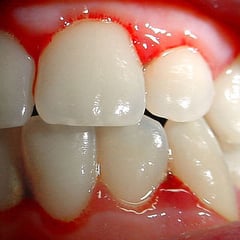 Gingivitis