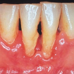 Periodontitis