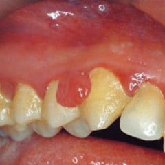 Agrandamiento Gingival
