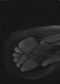 Wurzelverdickung Röntgen