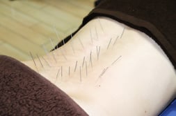 腰の鍼治療例
