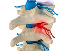 sciatica