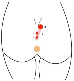 sinusectomy for sinus pilonidalis