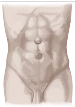 Epigastrische Hernie - hernienzentrum.berlin