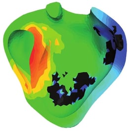 Simulation de l'activité électrique dans les 2 ventricules cardiaques. Elle permet de voir, sur les zones sombres, les tissus nécrosés dus à un infarctus du myocarde et qui conduisent moins bien les ondes électriques.(© Inria/Asclepios) 