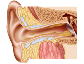 formation d'un bouchon de cerumen dans l'oreille
