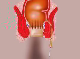 anal fistula laser treatment - proctology berlin - Proktologie Berlin