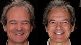 Sourire avant et aprés